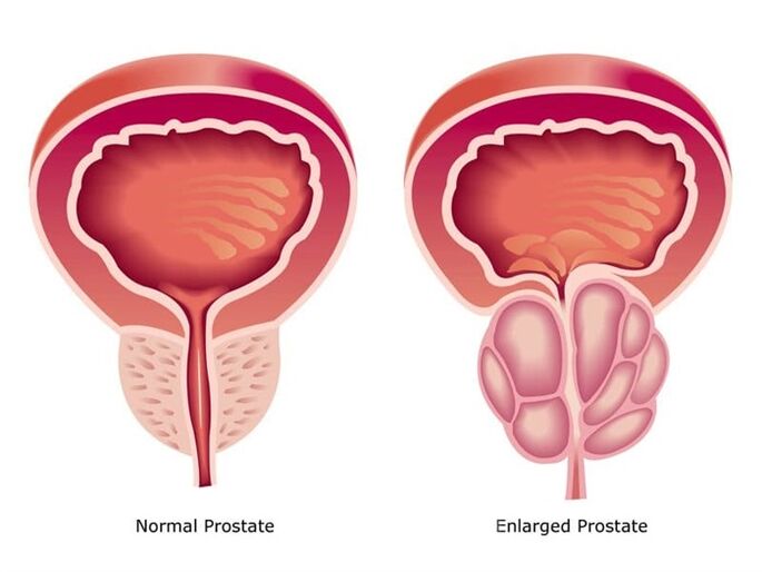 Prostovit normalizuoja prostatos darbą ir dydį