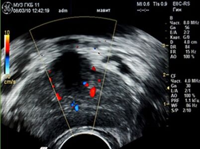 Ultragarsas parodė uždegimo židinius prostatoje