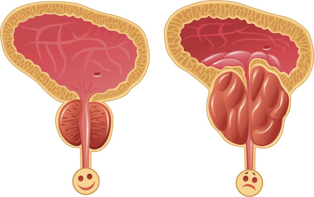 Prostatitas