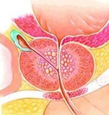 Prostatos adenoma