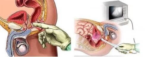 Instrumentinė prostatito diagnozė